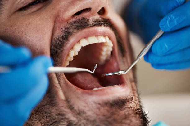 Best Emergency Dentist for Lost Fillings or Crowns in Kings Point, NY